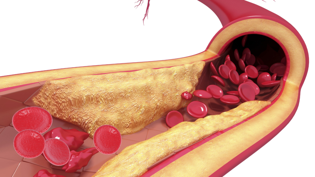 Cardiovascular Disease: Beyond LDL Cholesterol